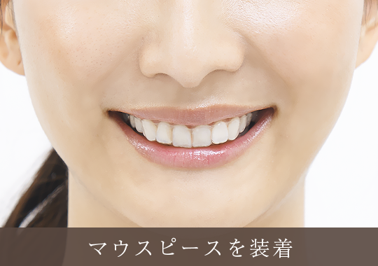 マウスピースを装着