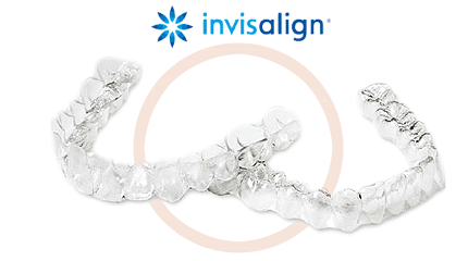 インビザライン矯正